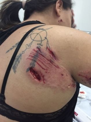 Ataque de pit bull em ponto de ônibus provoca corte profundo em jovem