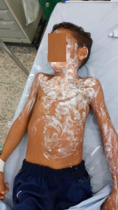 Abandonado pela avó: Menino queimado teve ferimentos no rosto e tórax