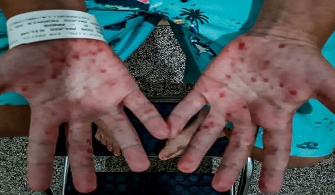 Alerta: Mato Grosso do Sul registou surto da doença ‘mão-pé-boca’ em crianças 
