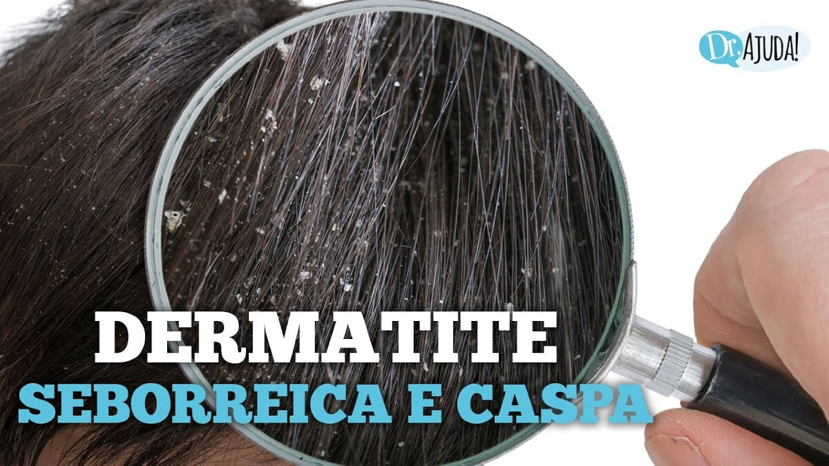 Dermatite Seborreica: Quais São As Causas? O Que Fazer? | Notícias De ...