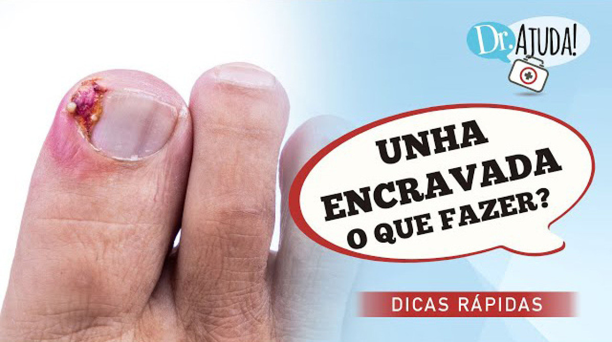 Unha encravada: o que fazer?