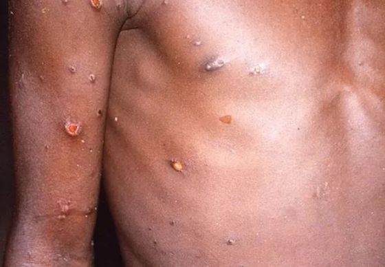 Vírus monkeypox, conhecido como “varíola dos macacos”