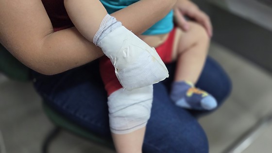 Queimaduras em crian&ccedil;as acendem alerta durante f&eacute;rias em Mato Grosso do Sul